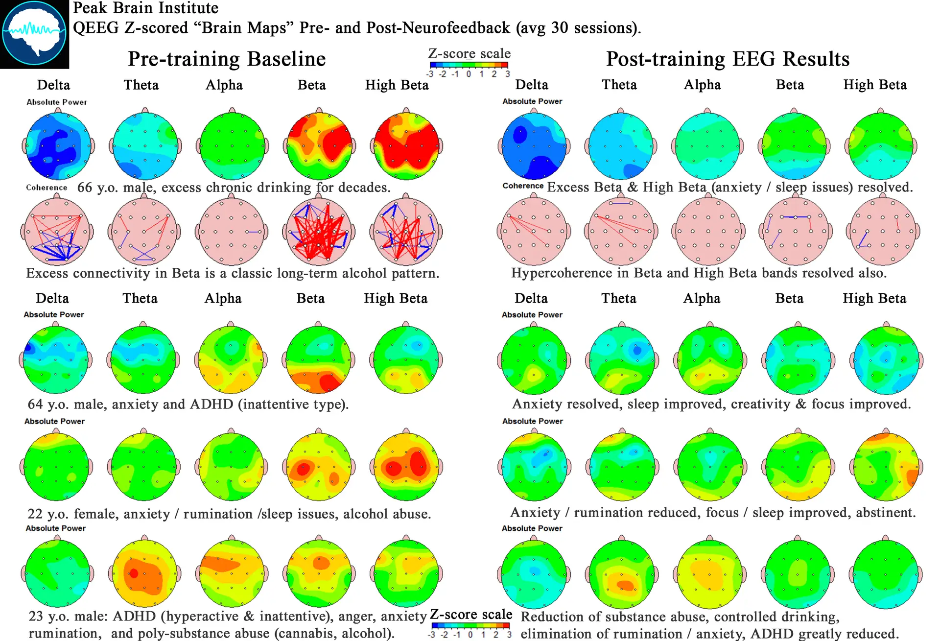 Pre and Post QEEG Brain Maps showing neurofeedback results